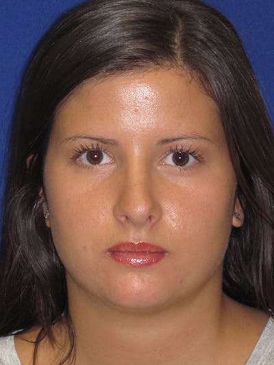 Rhinoplasty Before & After Gallery - Patient 4890859 - Image 8