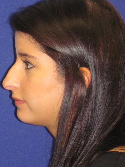 Rhinoplasty Before & After Gallery - Patient 4890860 - Image 1