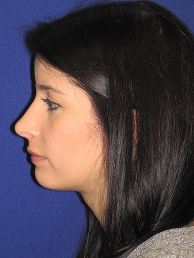 Rhinoplasty Before & After Gallery - Patient 4890860 - Image 2