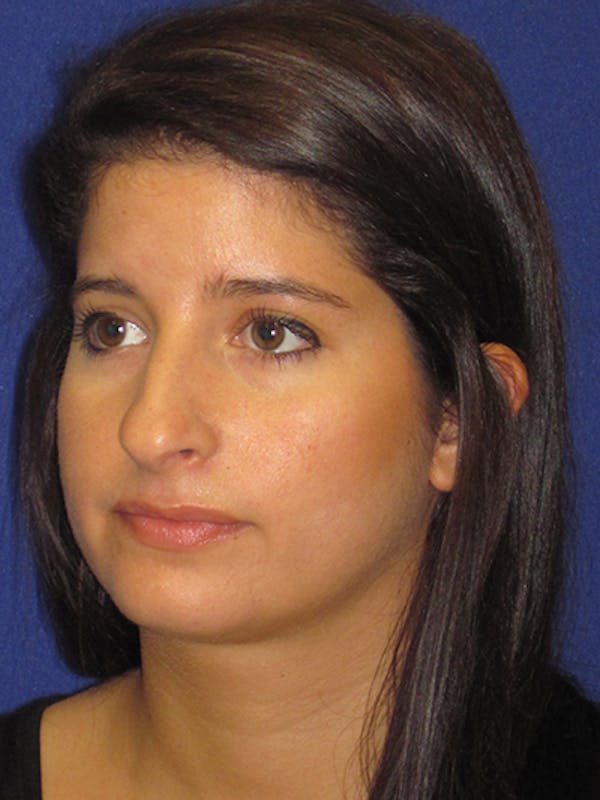 Rhinoplasty Before & After Gallery - Patient 4890860 - Image 3