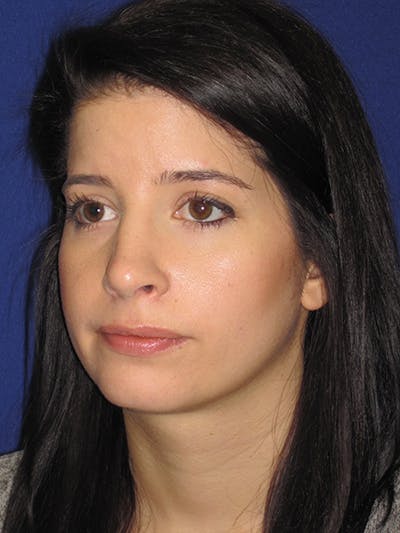 Rhinoplasty Before & After Gallery - Patient 4890860 - Image 4