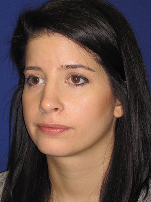 Rhinoplasty Gallery - Patient 4890860 - Image 4