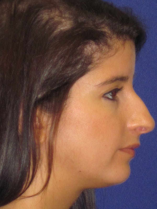 Rhinoplasty Before & After Gallery - Patient 4890860 - Image 5
