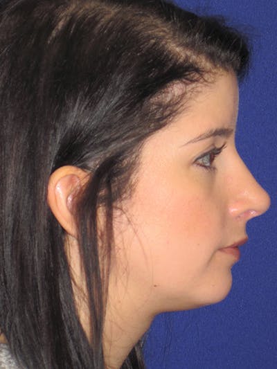 Rhinoplasty Before & After Gallery - Patient 4890860 - Image 6