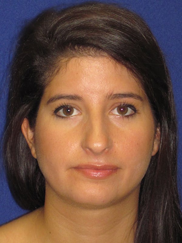 Rhinoplasty Before & After Gallery - Patient 4890860 - Image 7