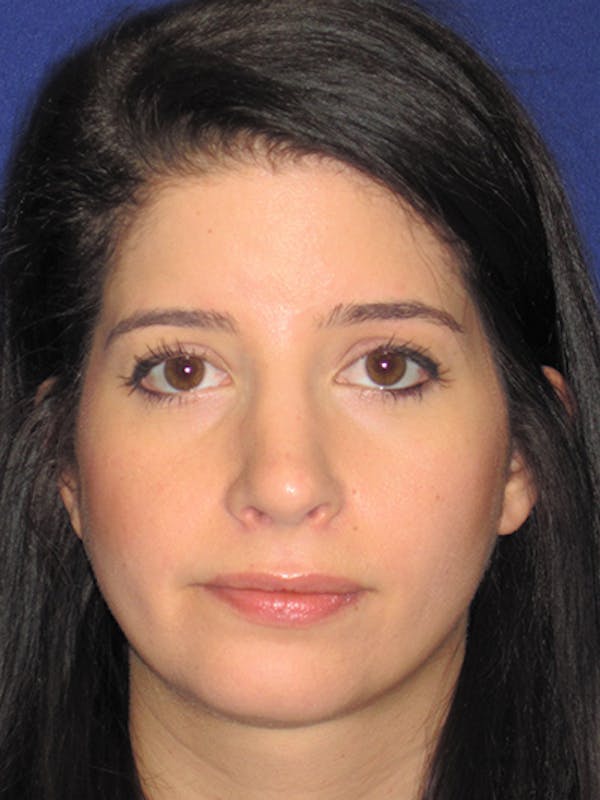 Rhinoplasty Before & After Gallery - Patient 4890860 - Image 8