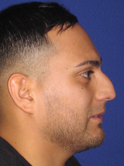 Rhinoplasty Before & After Gallery - Patient 4890864 - Image 1