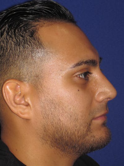 Rhinoplasty Before & After Gallery - Patient 4890864 - Image 2