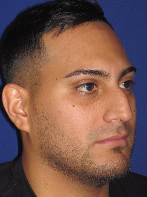 Rhinoplasty Gallery - Patient 4890864 - Image 3