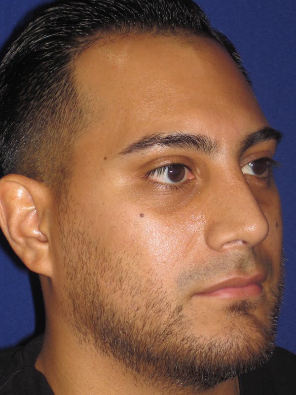 Rhinoplasty Before & After Gallery - Patient 4890864 - Image 4