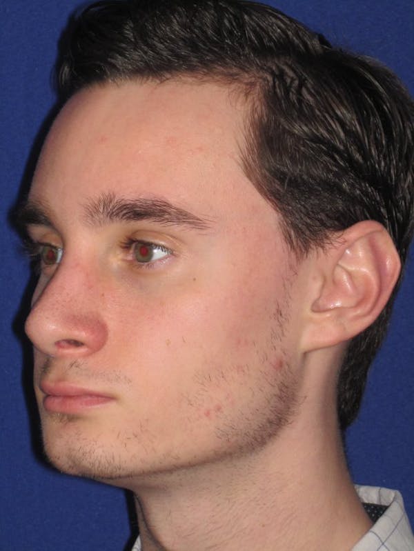 Rhinoplasty Before & After Gallery - Patient 4890891 - Image 2