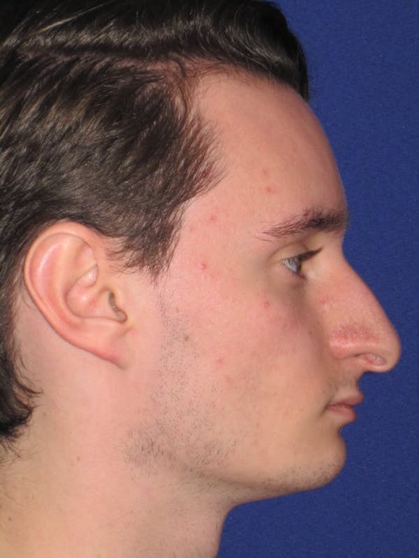 Rhinoplasty Before & After Gallery - Patient 4890891 - Image 3