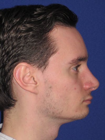 Rhinoplasty Before & After Gallery - Patient 4890891 - Image 4