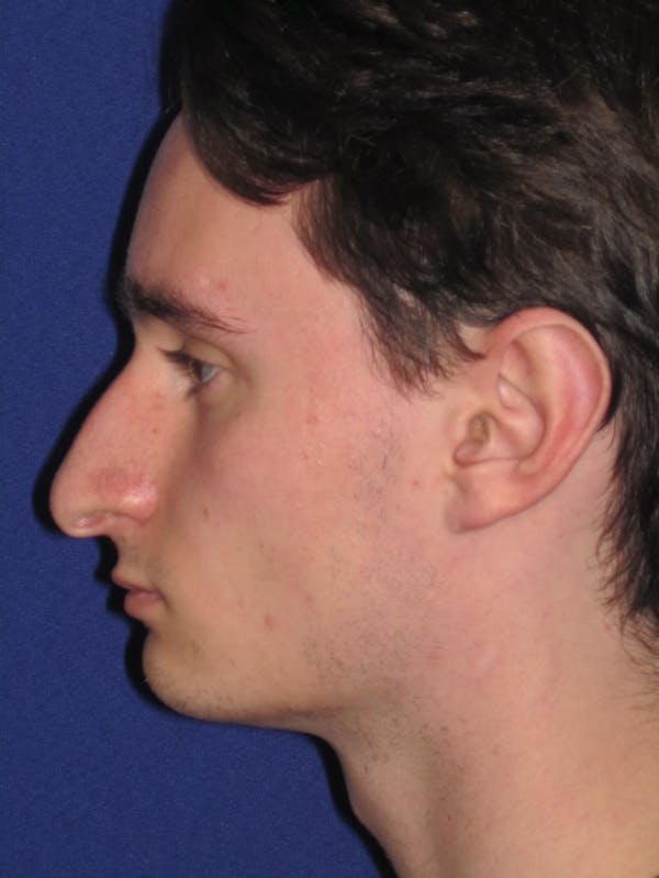 Rhinoplasty Before & After Gallery - Patient 4890891 - Image 5