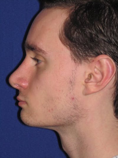 Rhinoplasty Before & After Gallery - Patient 4890891 - Image 6