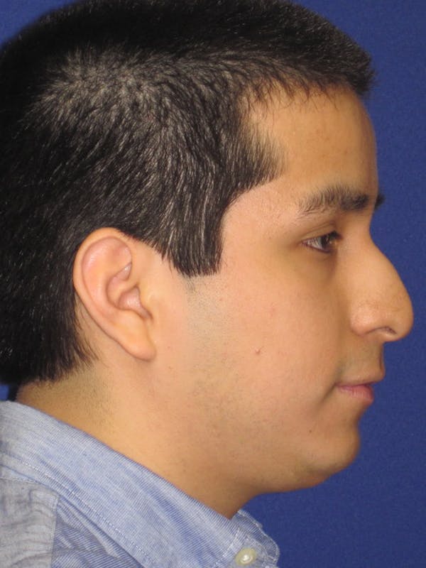 Rhinoplasty Before & After Gallery - Patient 4890904 - Image 1