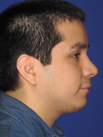 Rhinoplasty Before & After Gallery - Patient 4890904 - Image 2