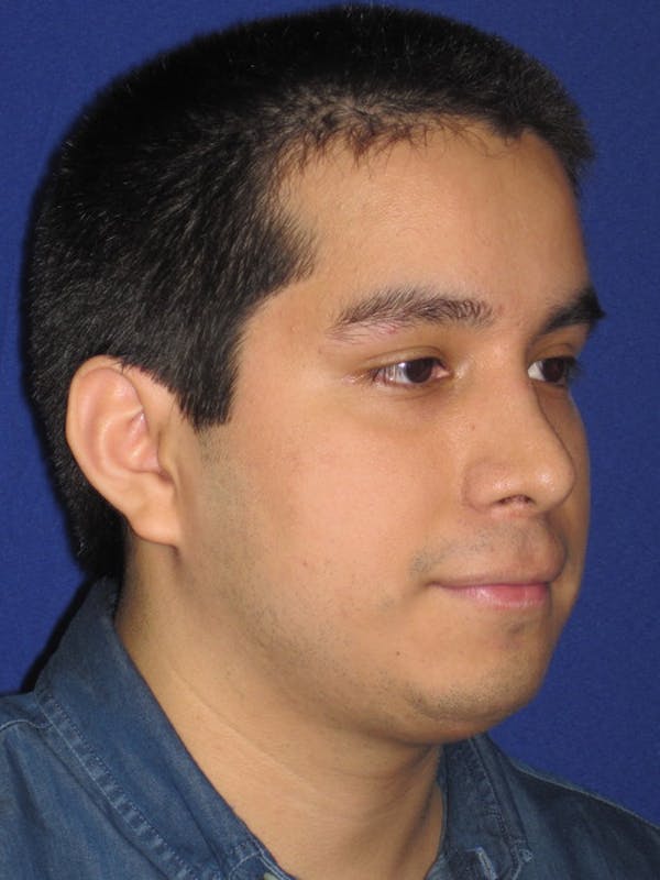 Rhinoplasty Gallery - Patient 4890904 - Image 6
