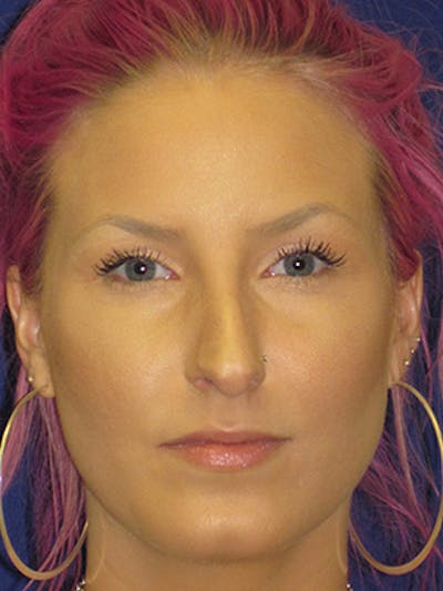 Rhinoplasty Before & After Gallery - Patient 4890906 - Image 1