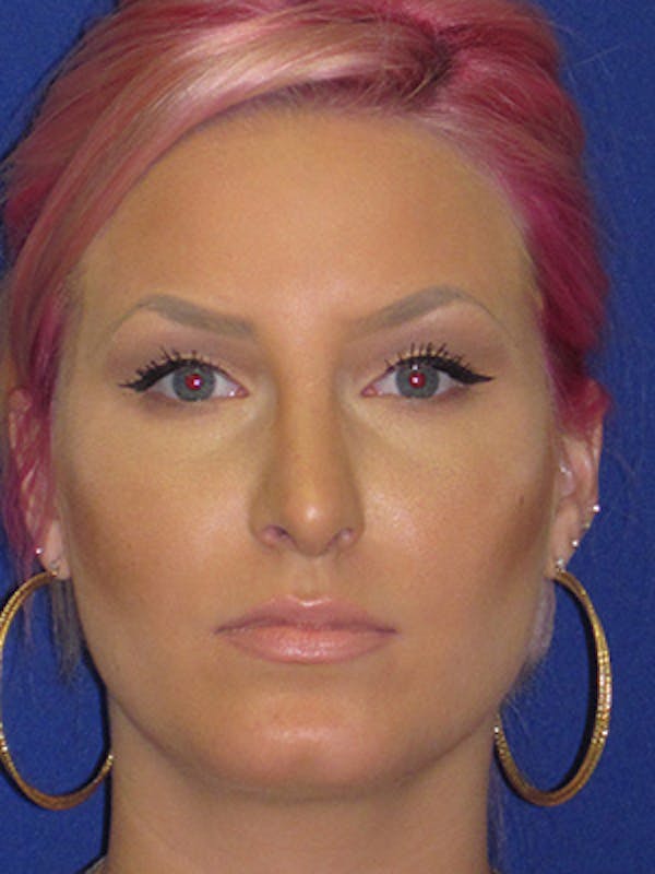 Rhinoplasty Before & After Gallery - Patient 4890906 - Image 2