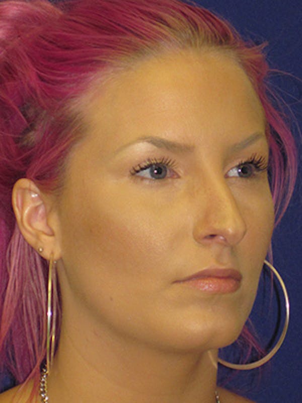 Rhinoplasty Before & After Gallery - Patient 4890906 - Image 3