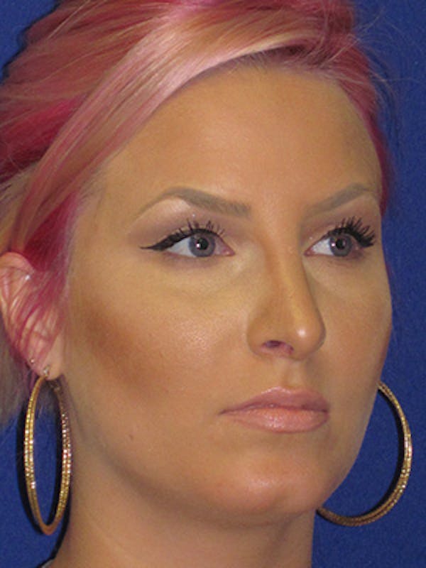 Rhinoplasty Before & After Gallery - Patient 4890906 - Image 4