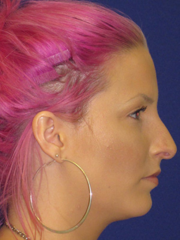 Rhinoplasty Before & After Gallery - Patient 4890906 - Image 5