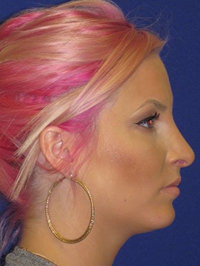 Rhinoplasty Before & After Gallery - Patient 4890906 - Image 6