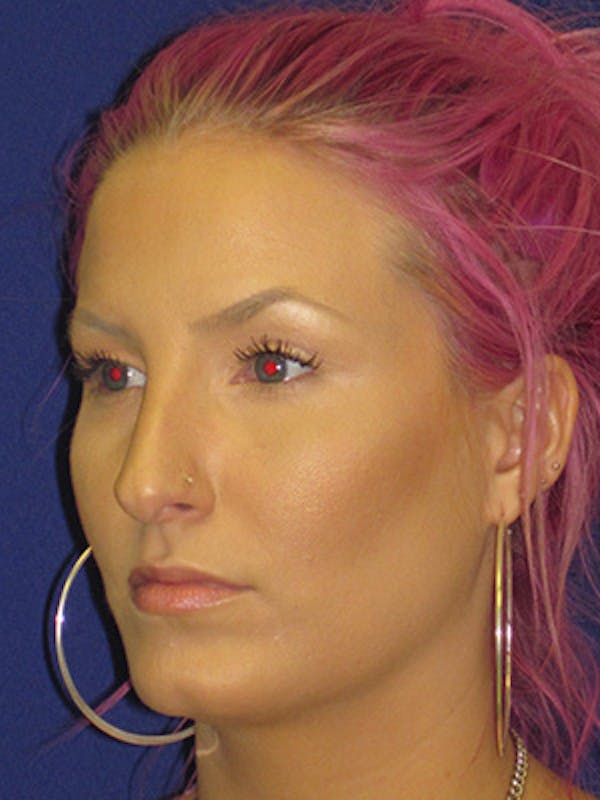 Rhinoplasty Before & After Gallery - Patient 4890906 - Image 7