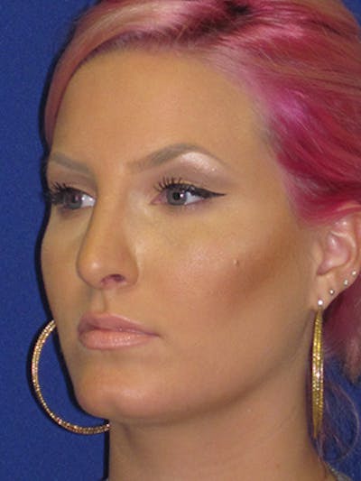 Rhinoplasty Before & After Gallery - Patient 4890906 - Image 8
