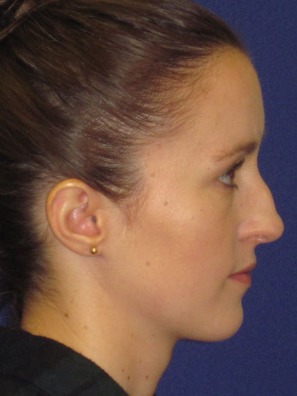 Rhinoplasty Before & After Gallery - Patient 4890907 - Image 1