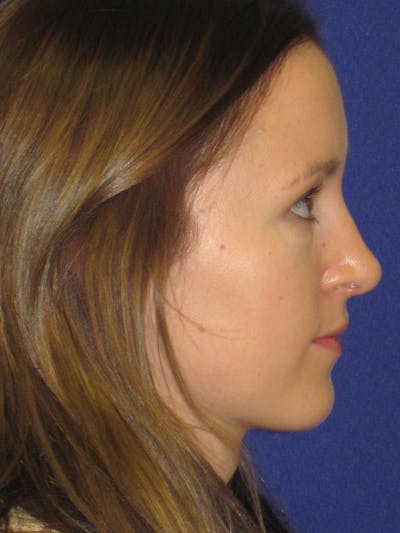 Rhinoplasty Before & After Gallery - Patient 4890907 - Image 2