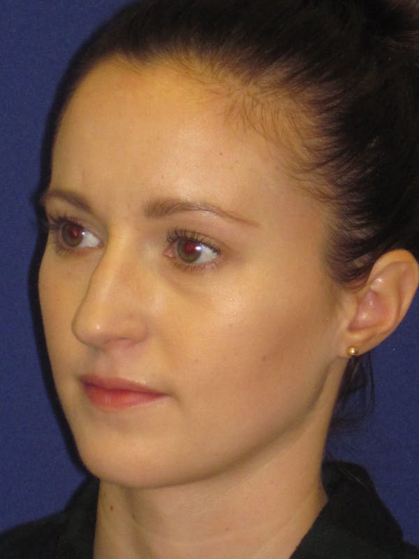 Rhinoplasty Before & After Gallery - Patient 4890907 - Image 3