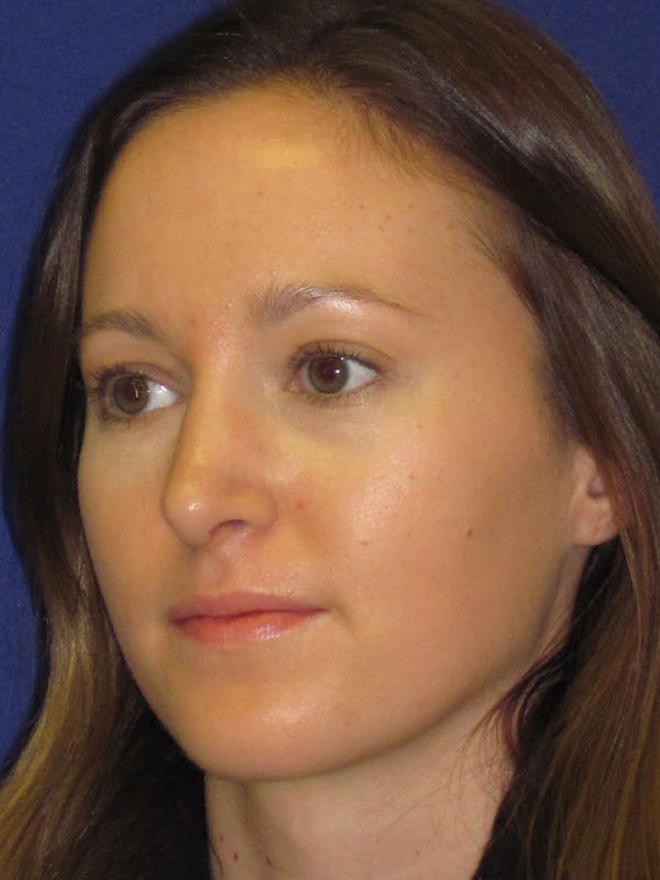 Rhinoplasty Before & After Gallery - Patient 4890907 - Image 4