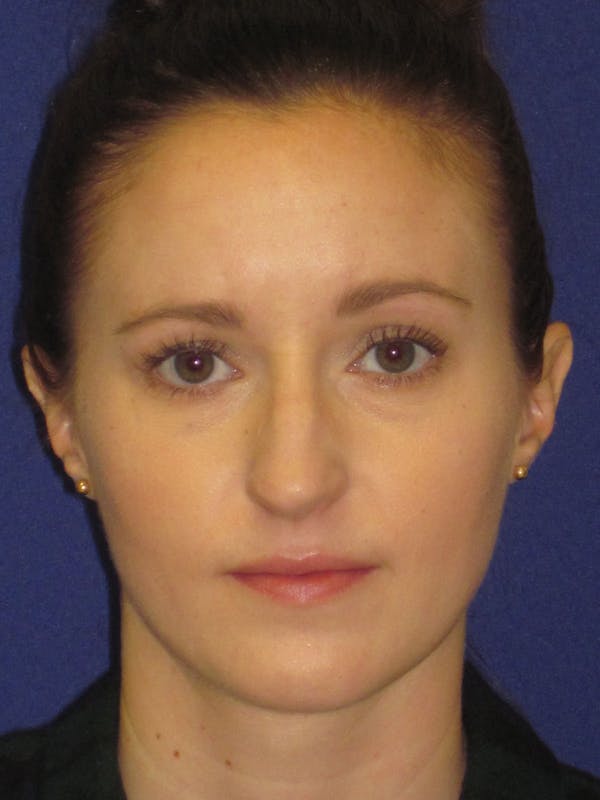 Rhinoplasty Before & After Gallery - Patient 4890907 - Image 5