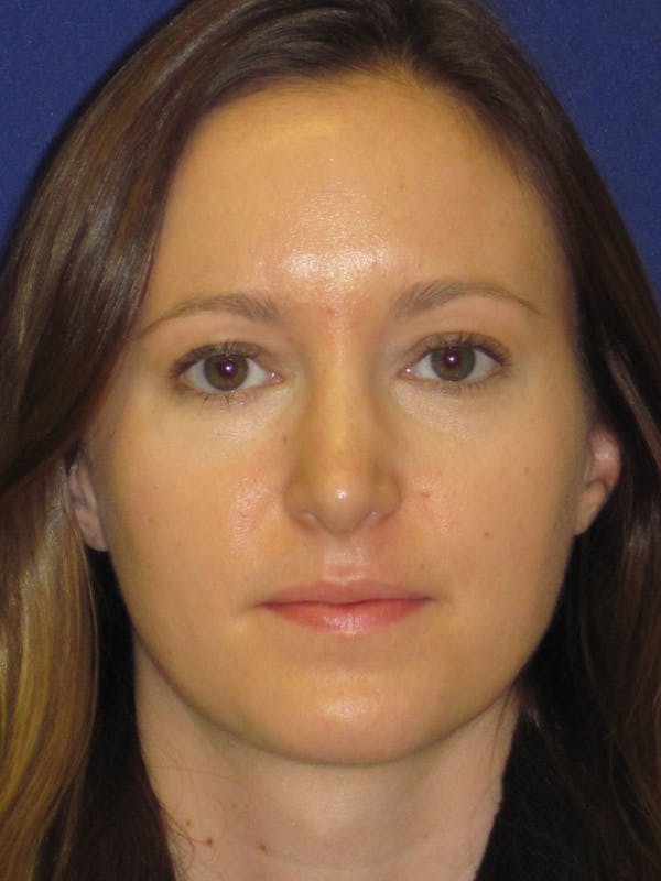 Rhinoplasty Before & After Gallery - Patient 4890907 - Image 6