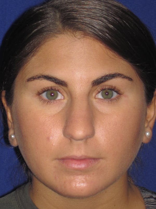 Rhinoplasty Before & After Gallery - Patient 4890908 - Image 1