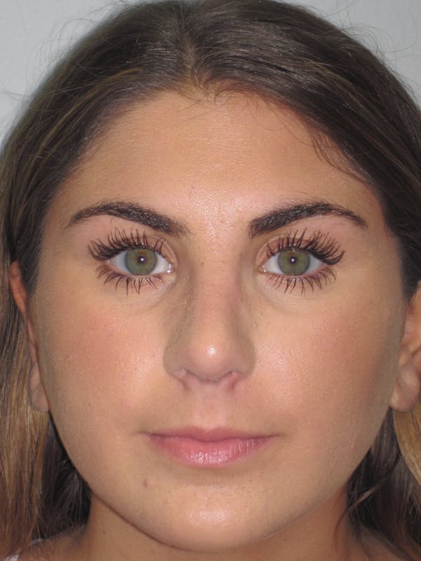 Rhinoplasty Before & After Gallery - Patient 4890908 - Image 2