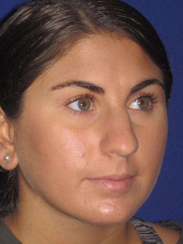 Rhinoplasty Before & After Gallery - Patient 4890908 - Image 3
