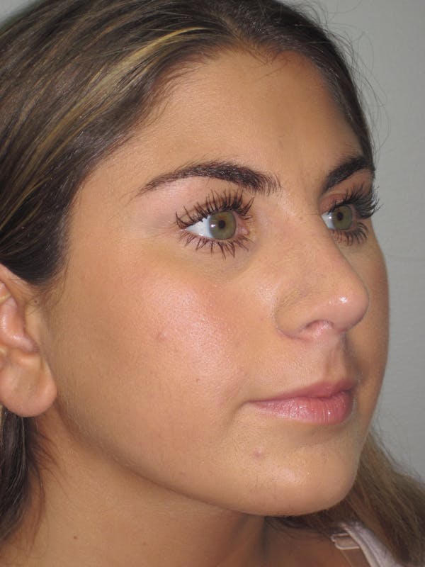 Rhinoplasty Before & After Gallery - Patient 4890908 - Image 4