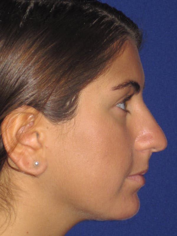 Rhinoplasty Before & After Gallery - Patient 4890908 - Image 5