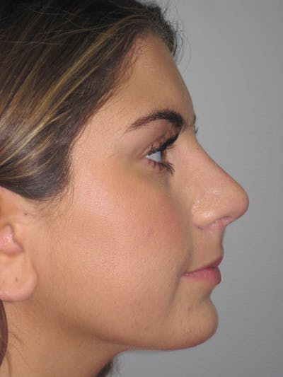 Rhinoplasty Before & After Gallery - Patient 4890908 - Image 6