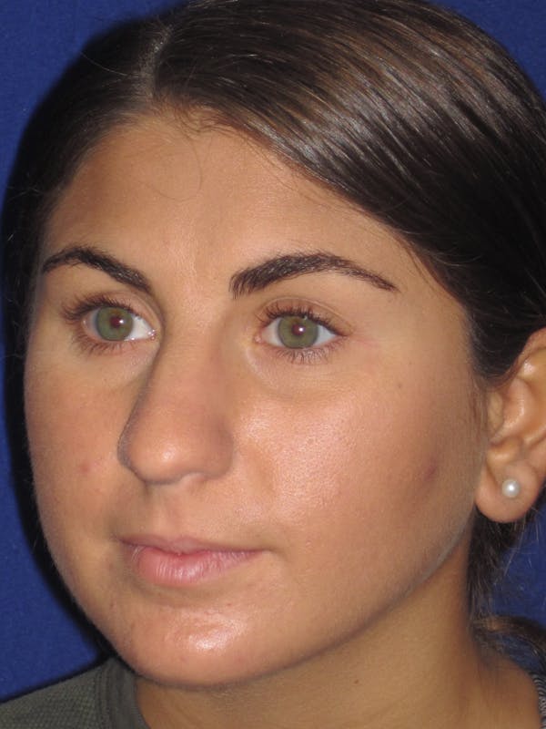 Rhinoplasty Before & After Gallery - Patient 4890908 - Image 7