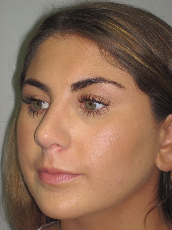 Rhinoplasty Before & After Gallery - Patient 4890908 - Image 8