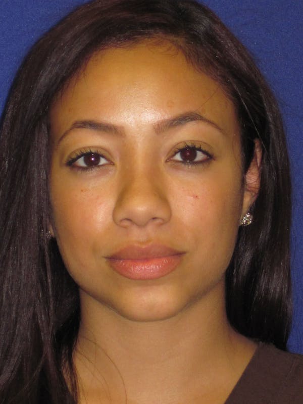 Rhinoplasty Before & After Gallery - Patient 4890911 - Image 1