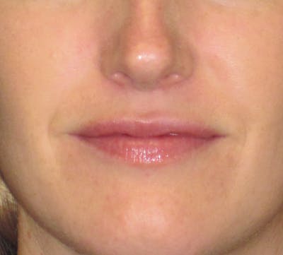 Lip Augmentation Before & After Gallery - Patient 4890910 - Image 1
