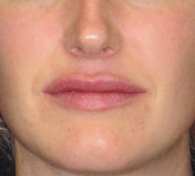 Lip Augmentation Before & After Gallery - Patient 4890910 - Image 2