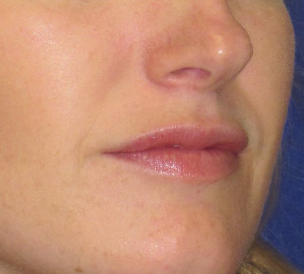 Lip Augmentation Before & After Gallery - Patient 4890910 - Image 3