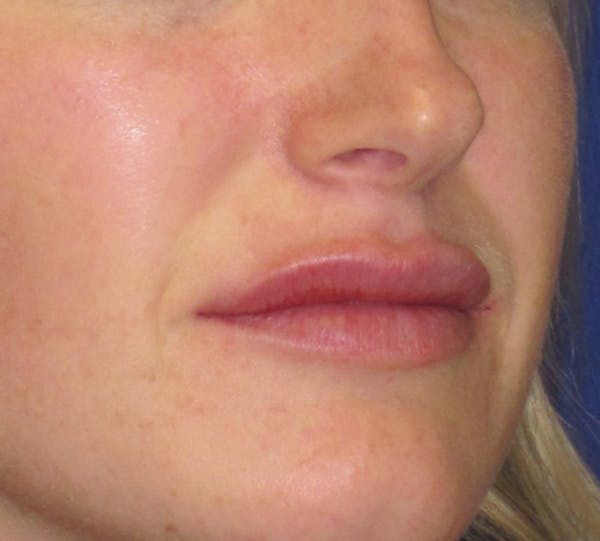 Lip Augmentation Before & After Gallery - Patient 4890910 - Image 4