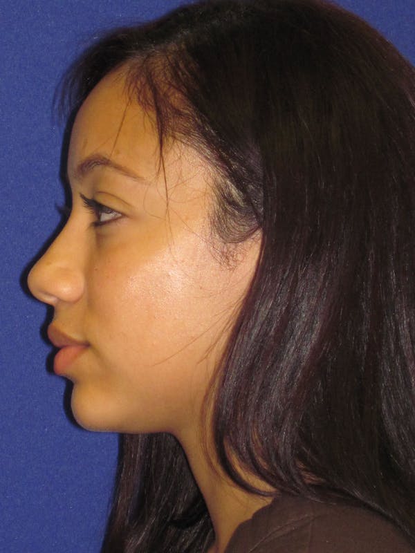 Rhinoplasty Before & After Gallery - Patient 4890911 - Image 5